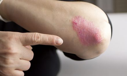 Psoriatic Arthritis: Your Rheumatologist Might Be Able To Help (Part 1)