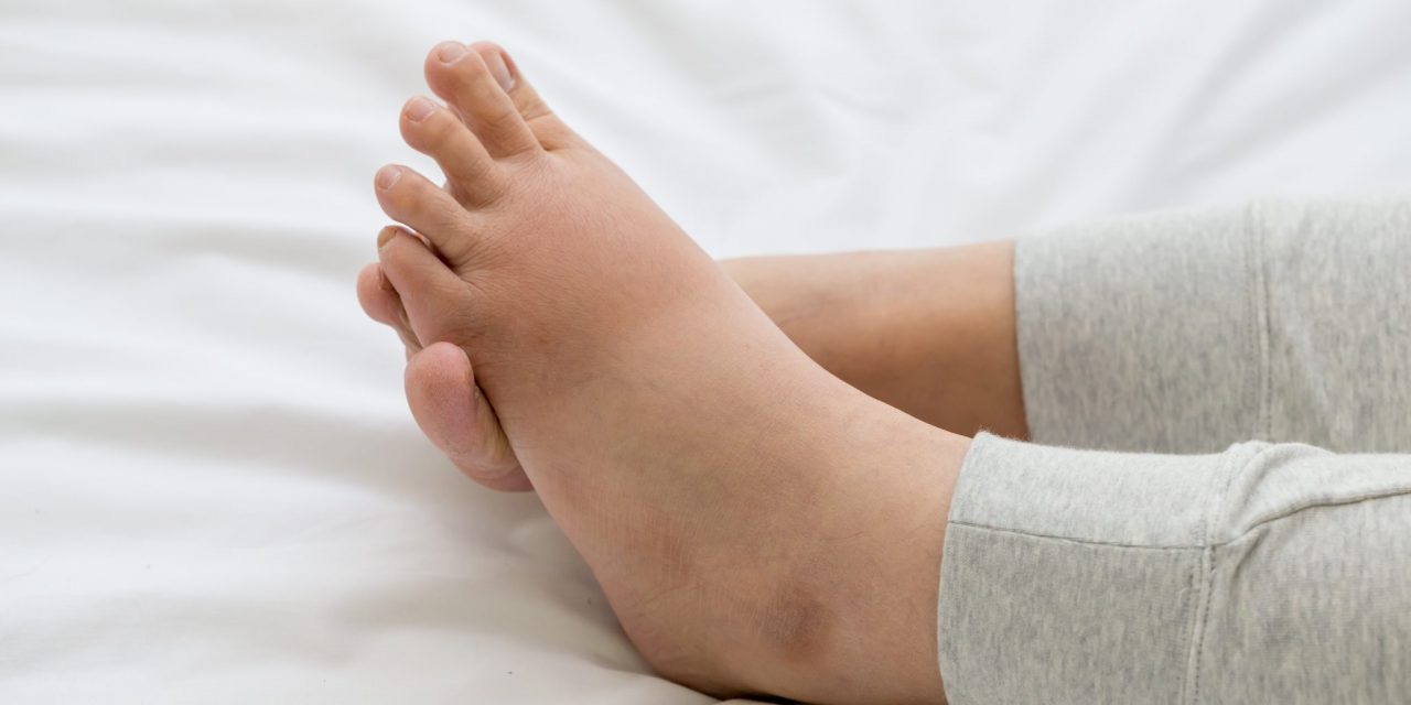 Leg Swelling: Causes, Diagnosis, & Treatment