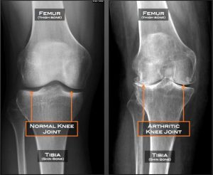 x-ray of knee